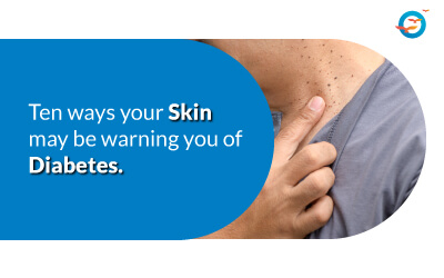 Skin May Be Warning You of Diabetes