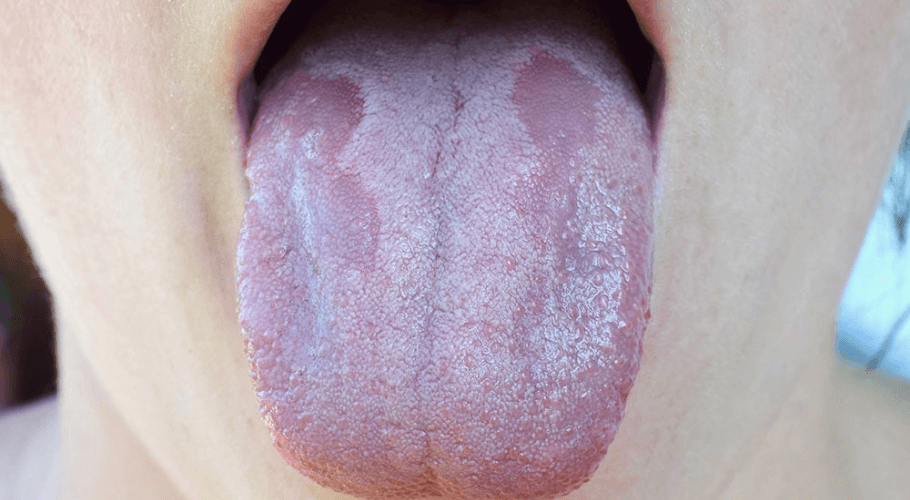 Oral Thrush