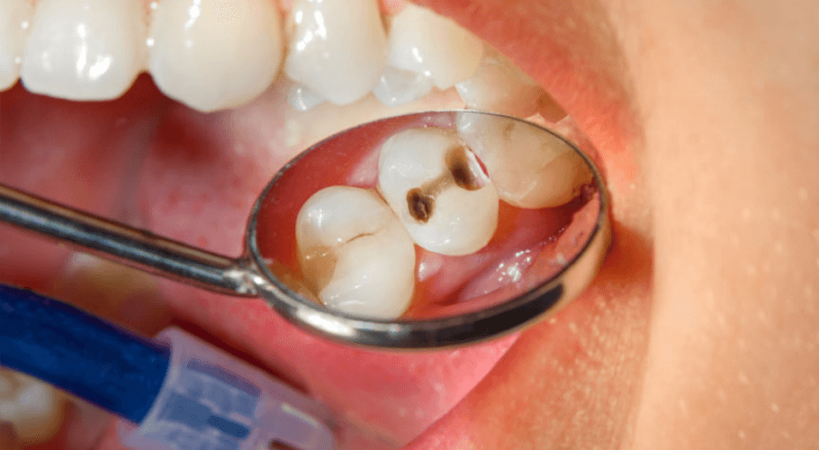 Risk of dental cavities