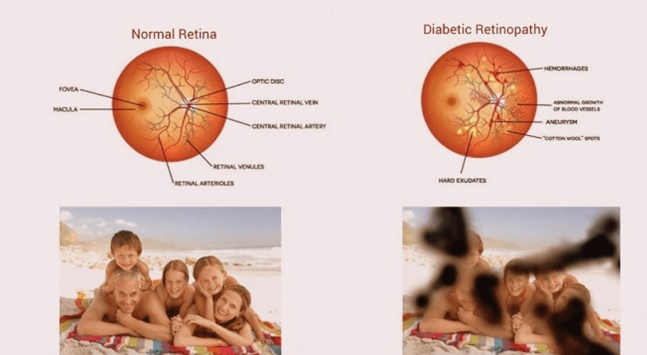 Diabetic Retinopathy