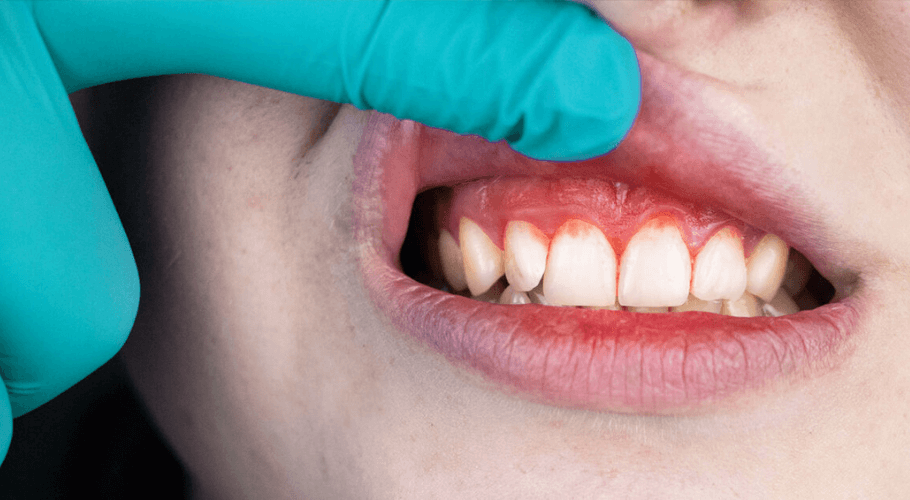 	Gingivitis and periodontitis (gum inflammation)	