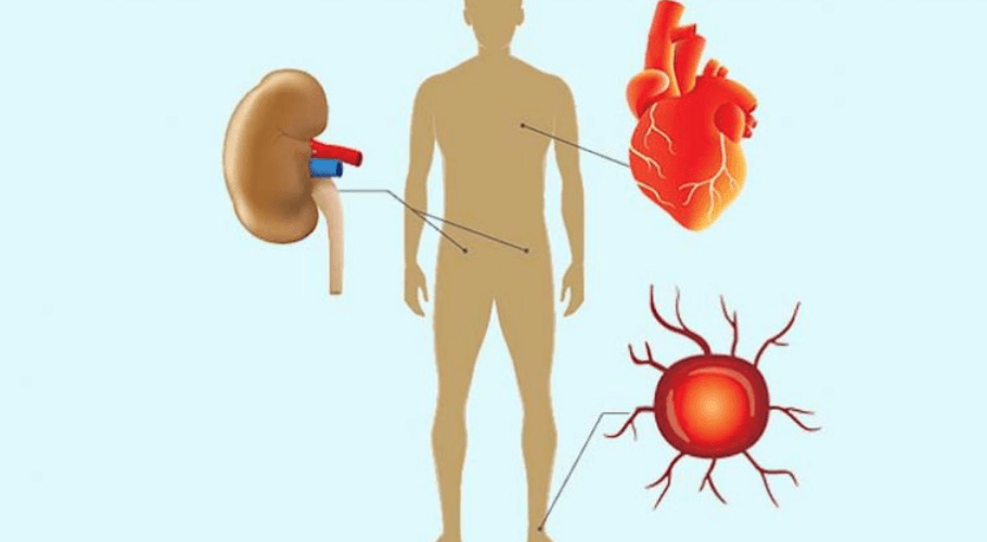 Microvascular Complications of Diabetes	