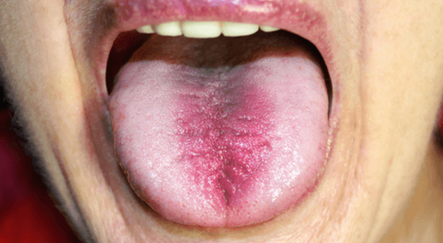 Burning in the mouth or tongue