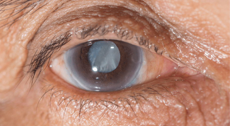 Eye Cataract